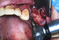 Implantati zobni vsadki operacija v zivo 3