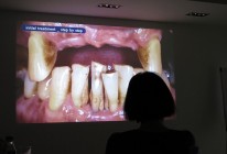 Implantati zobni vsadki predavanje 2