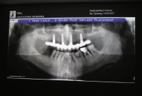 Implantati zobni vsadki predavanje 3